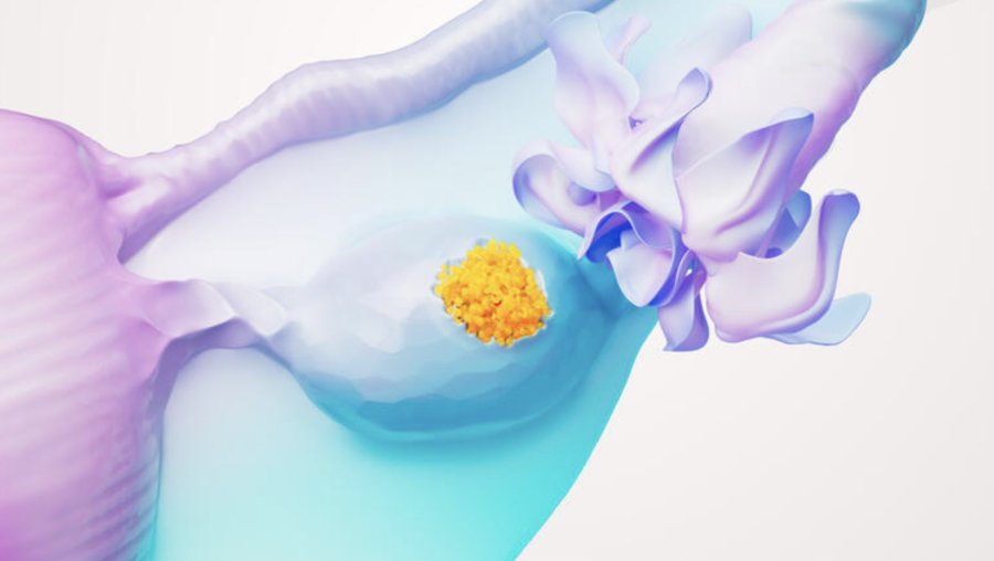 Concienciar para salvar vidas: la importancia de la detección temprana y el acceso a tratamientos innovadores para el Cáncer de Ovario