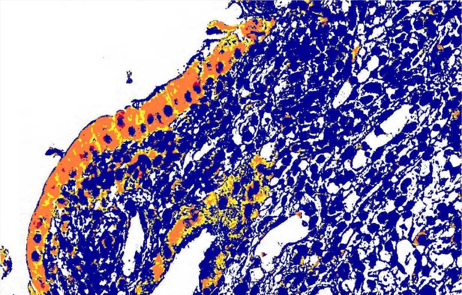La mitad de los pacientes con enfermedades inflamatorias intestinales no logran un control adecuado de la enfermedad, y solo el 10% logra la remisión completa