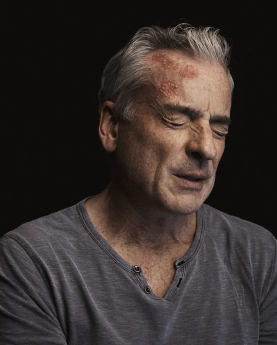 Los 7 mitos m&aacute;s comunes del herpes z&oacute;ster